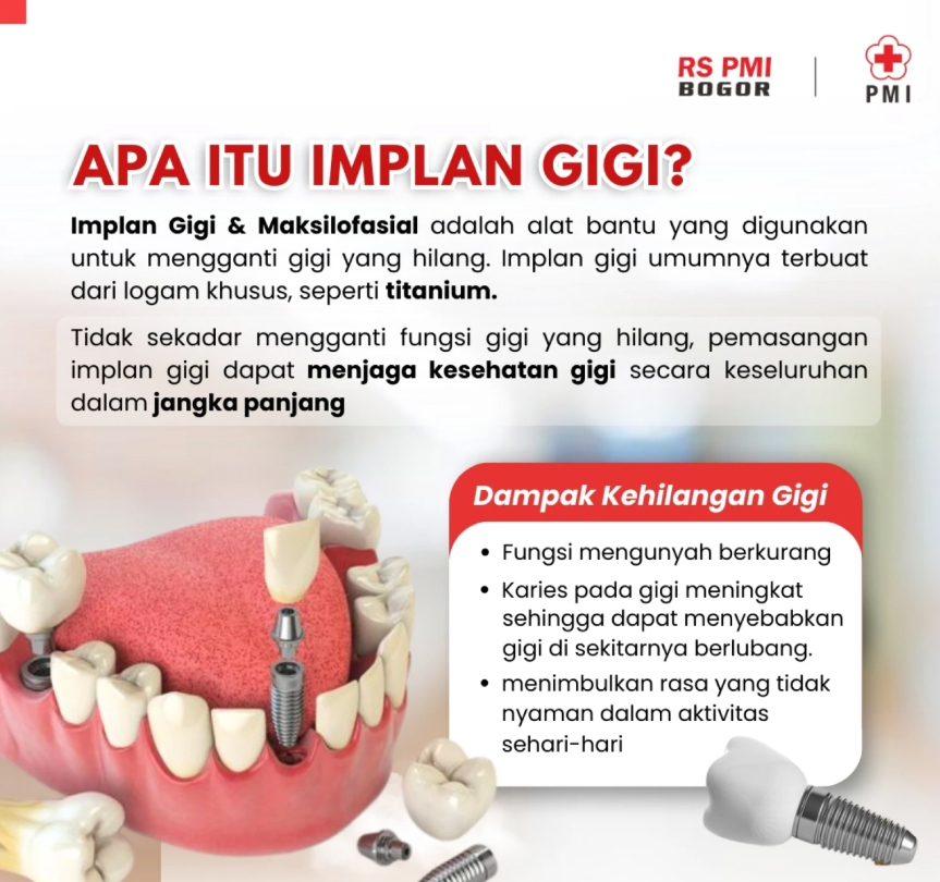 APA ITU IMPLAN GIGI?