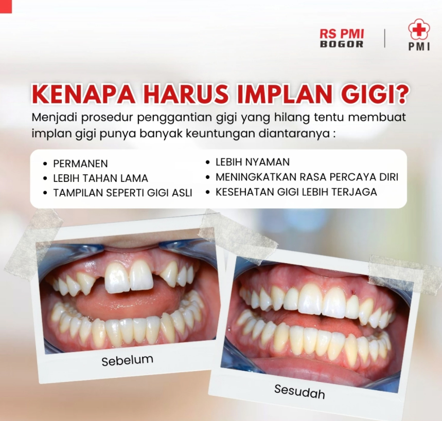 KENAPA HARUS IMPLAN GIGI?