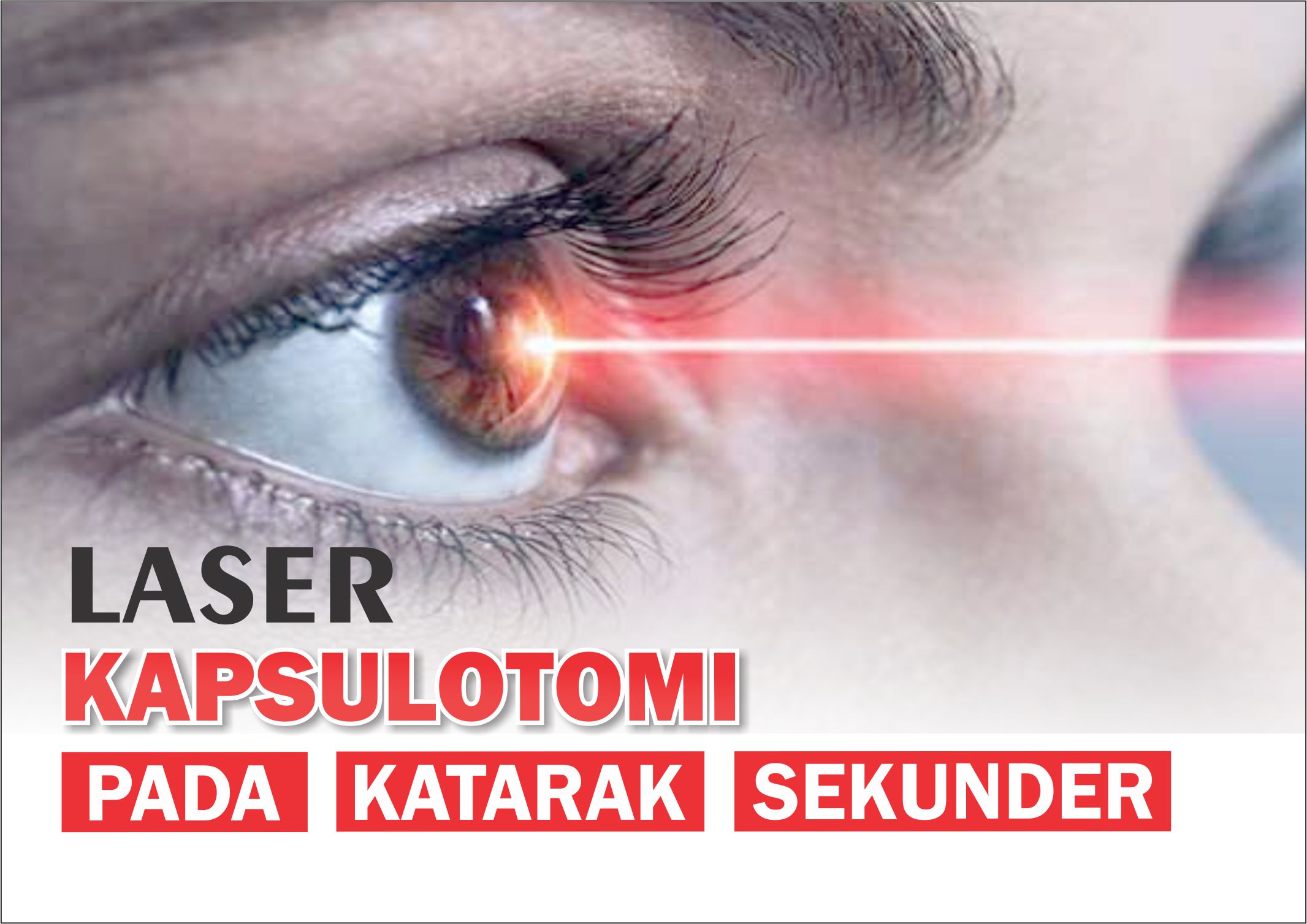 BEBAS KATARAK DENGAN LASER KAPSULOTOMI